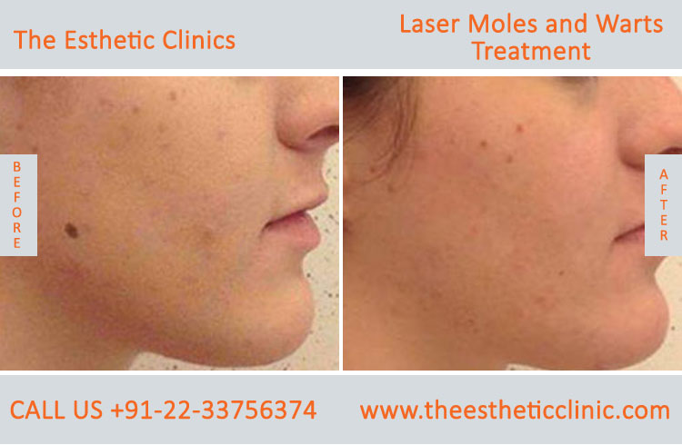 Moles Wart Skin Tags Laser Treatment before after photos in mumbai india (6)